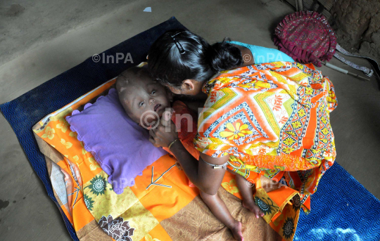 Baby Runa Begum (Roona Begum), Hydrocephalus patient 