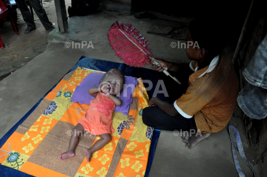 Baby Runa Begum (Roona Begum), Hydrocephalus patient 