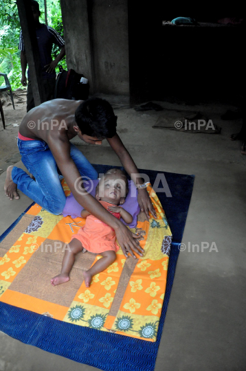 Baby Runa Begum (Roona Begum), Hydrocephalus patient 