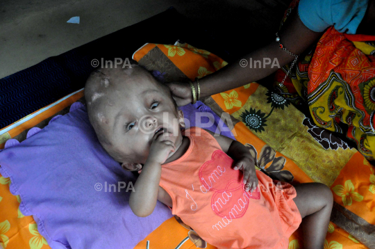 Baby Runa Begum (Roona Begum), Hydrocephalus patient 