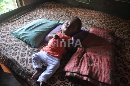 Baby Runa Begum (Roona Begum), Hydrocephalus patient