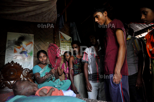 Baby Runa Begum (Roona Begum), Hydrocephalus patient