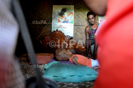 Baby Runa Begum (Roona Begum), Hydrocephalus patient