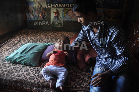 Baby Runa Begum (Roona Begum), Hydrocephalus patient