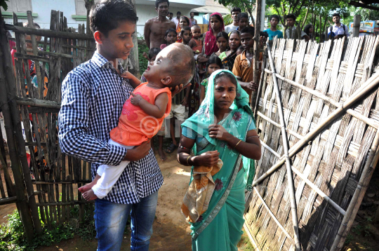 Baby Runa Begum (Roona Begum), Hydrocephalus patient