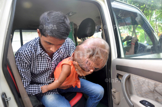 Baby Runa Begum (Roona Begum), Hydrocephalus patient