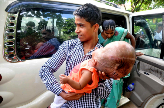 Baby Runa Begum (Roona Begum), Hydrocephalus patient