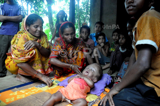 Baby Runa Begum (Roona Begum), Hydrocephalus patient