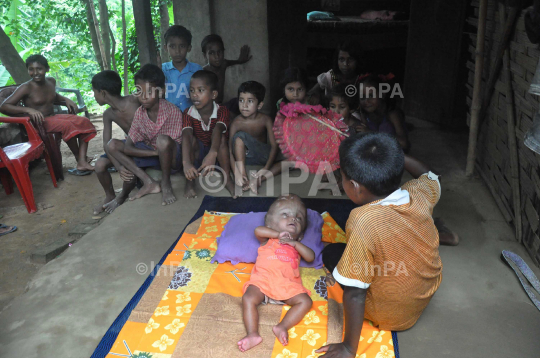 Baby Runa Begum (Roona Begum), Hydrocephalus patient